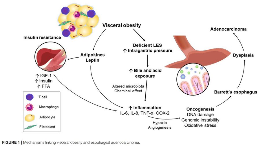 Visceral obesity and esophageal cancer